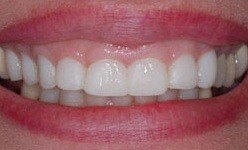 Stubby teeth before smile correction