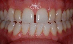 Smile with gap between front teeth
