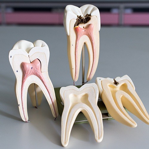 Model of the inside of a healthy tooth and tooth in need of root canal therapy