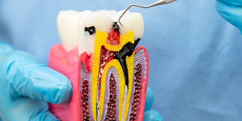 A model of an infected tooth