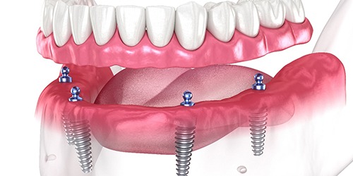 Dental implant abutments in Flower Mound