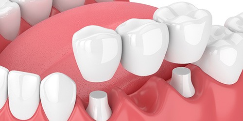 illustration traditional dental bridge in Flower Mound 