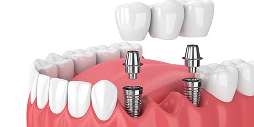 illustration implant dental bridge in Flower Mound  