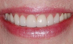 Smile after top teeth were brightened with cosmetic dentistry