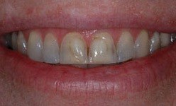 Smile with severely discolored top teeth