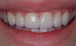 Bright white healthy smile