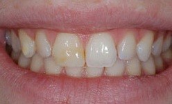 Smile with line of yellow through top front tooth