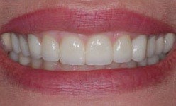 Healthy smile beautiful smile after cosmetic dentistry