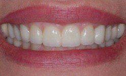 Healthy smile beautiful smile after cosmetic dentistry