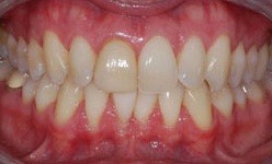 Yellowed smile before professional teeth whitening