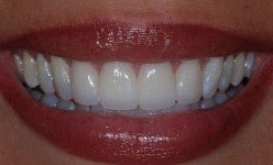 Smile with perfected teeth after cosmetic dentistry