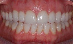 Smile with closed gap between front teeth