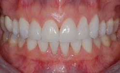 Smile with repaired bottom tooth