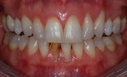 Smile with yellow and damaged bottom tooth