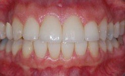 Smile with gaps closed between top and bottom front teeth