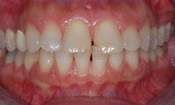 Smile with gaps between top and bottom front teeth