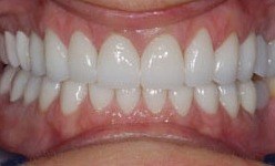 Bright smile after teeth whitening