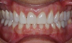 Yellowed smile before teeth whitening