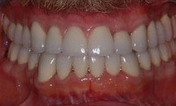 Bright white smile after cosmetic dentistry