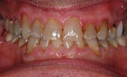 Severely yellowed smile before cosmetic dentistry