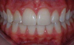 Smile with large healthy teeth after cosmetic dentistry