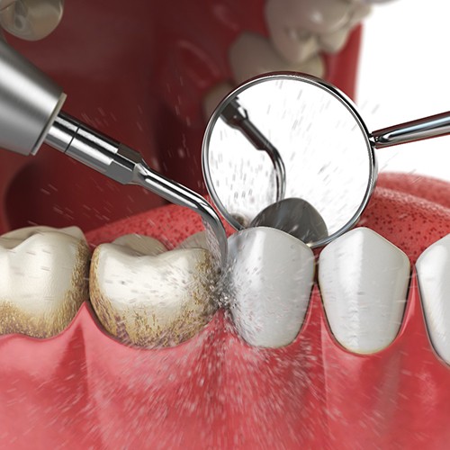 3D render of a dental cleaning