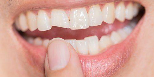 Closeup of smile with chipped front tooth