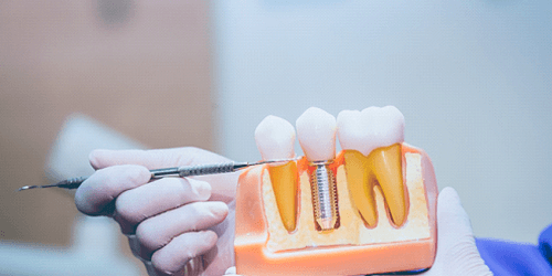 An illustration of implant parts, which affect the cost of dental implants in Flower Mound