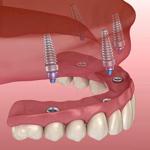 Digital illustration of how implant dentures in Flower Mound are placed