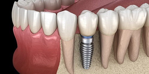Aniamted smile with dental implant supported dental crown