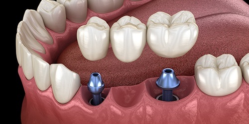 Animated smile during dental implant supported fixed bridge placement