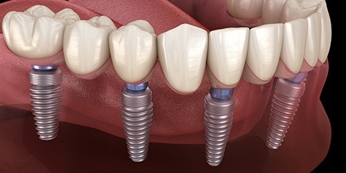 Animated smile with dental implant supported denture