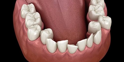 Illustration of crooked teeth