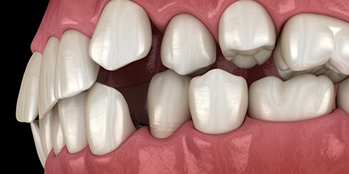 Illustration of gapped teeth