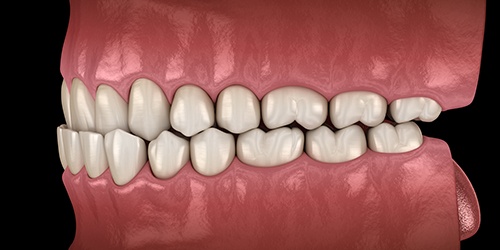 Illustration of an underbite