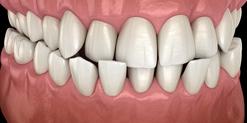 Illustration of a crossbite