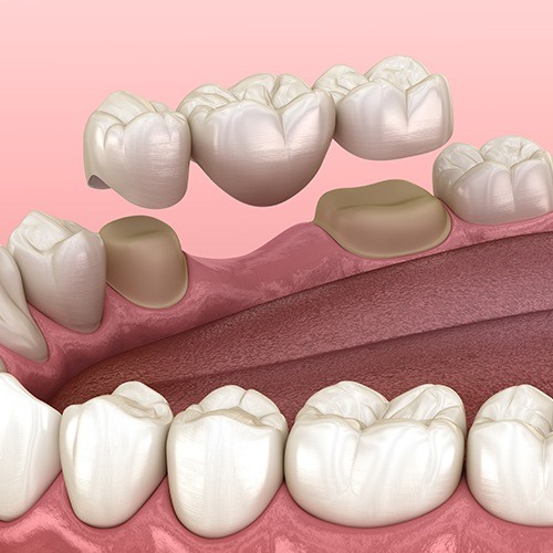 Animated smile during dental bridge placement