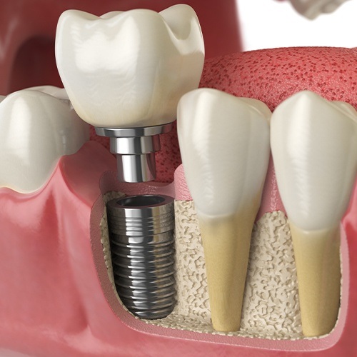 Animated smile during dental implant supported dental crown placement