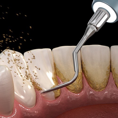 Animated smile during scaling and root planing treatment