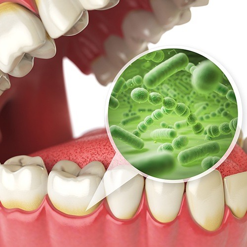 Animated smile with advanced periodontal disease before periogard antibiotic therapy