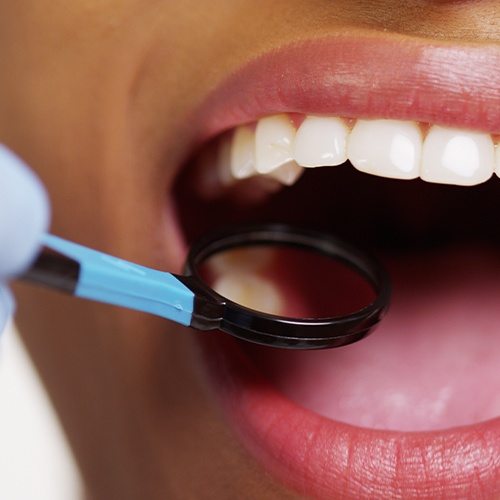 Closeup of patient receiving oral cancer screening