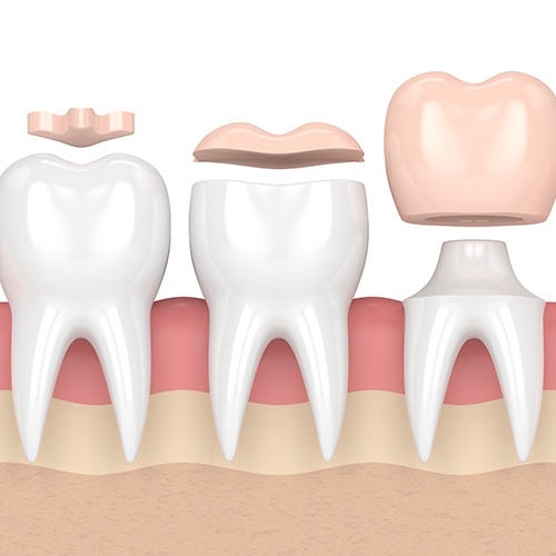 Animated teeth comparing fillings inlays and dental crowns