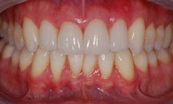 Brilliant white smile after professional teeth whitening