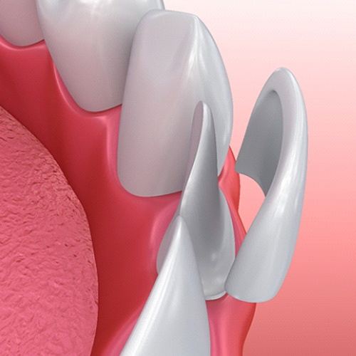 Illustration of veneer being placed on tooth