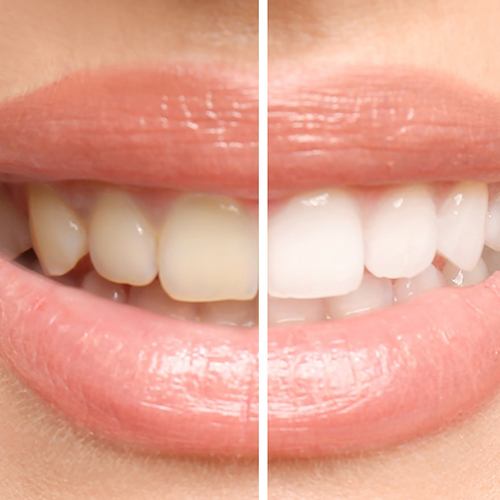Closeup of patient's smile before and after teeth whitening
