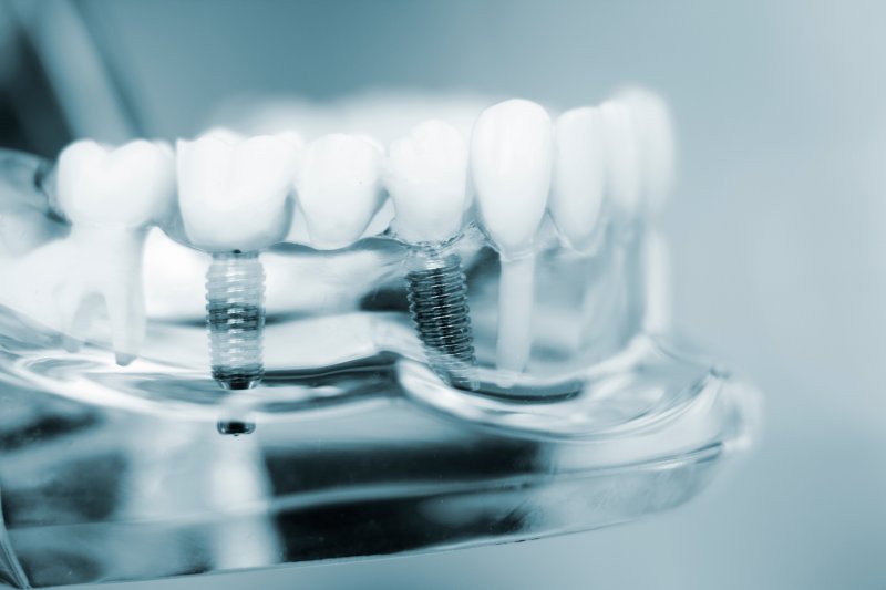 Close-up of dental implants in model jaw