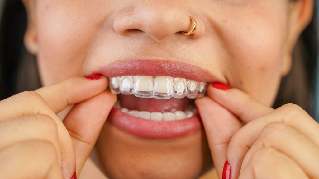 Closeup of woman removing clear aligners from upper arch